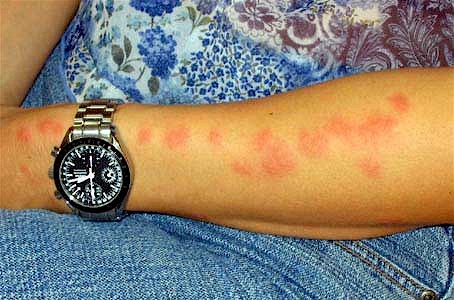 bed_bug_bites1.jpg