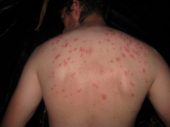 Bed-Bug-Bites-on-Back.jpg